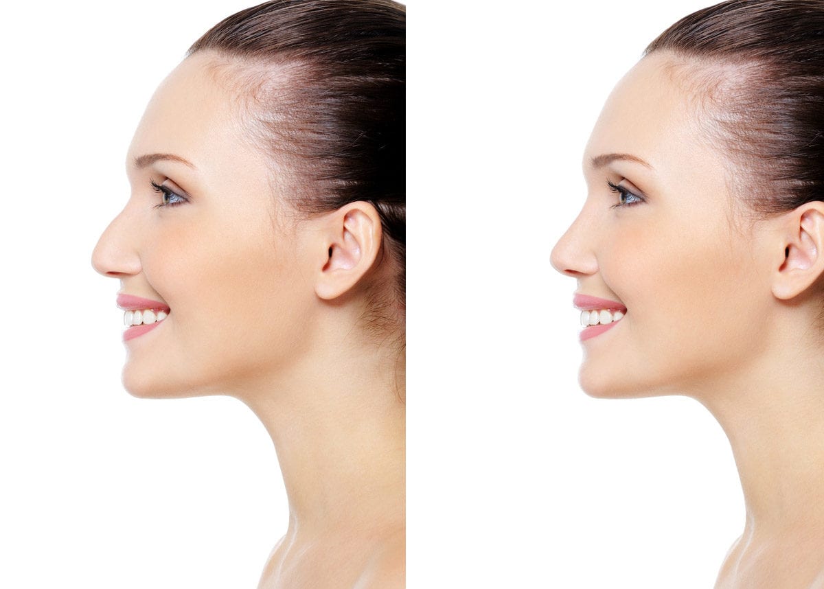 how-is-nose-aesthetics-performed-nose-aesthetics-male-nose
