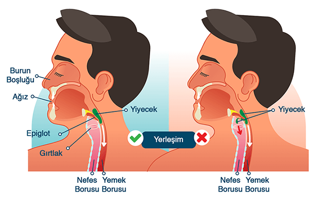 Yutma Güçlüğü